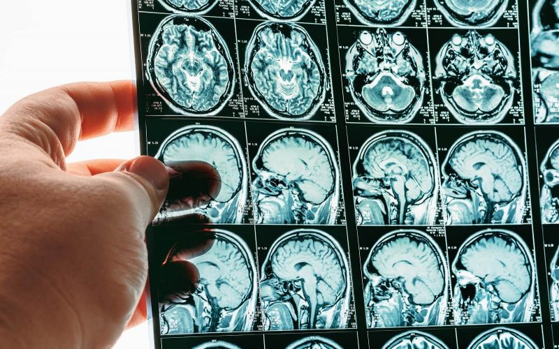 What Is a TBI?