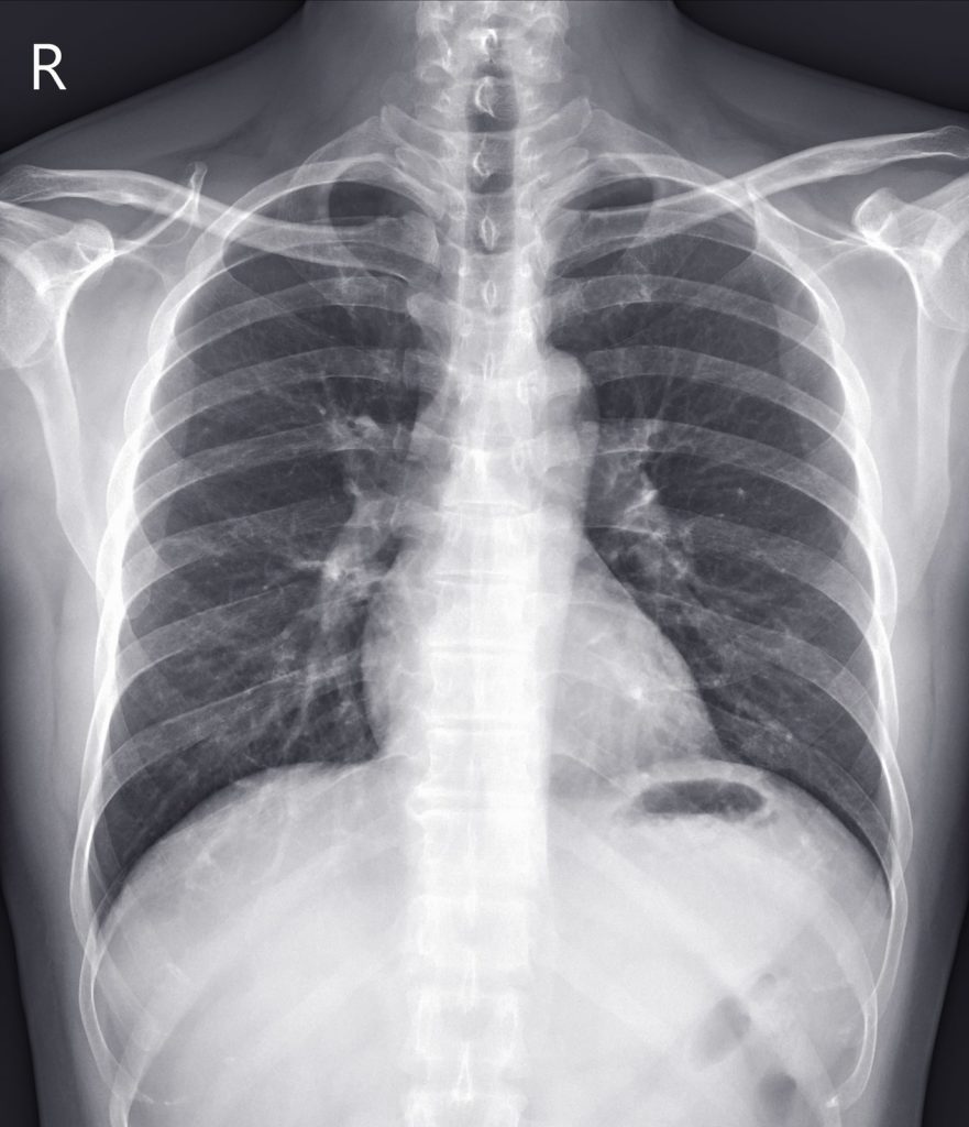 Diagnosing Chest Injury After Accident