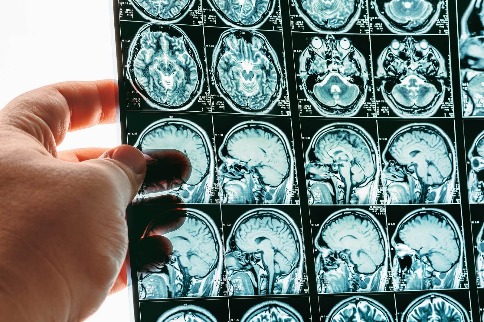 What Is a TBI? - Boohoff Law P.A.